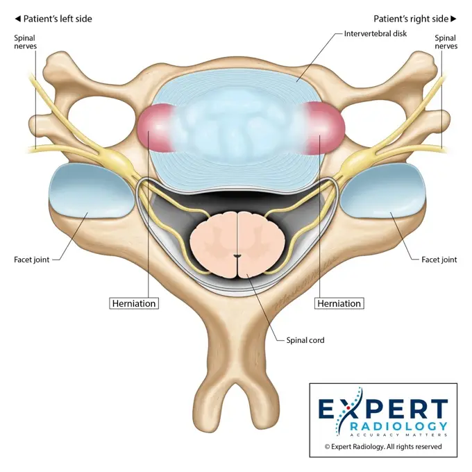 PrecisionPlus report page with an annotated cervical spine image