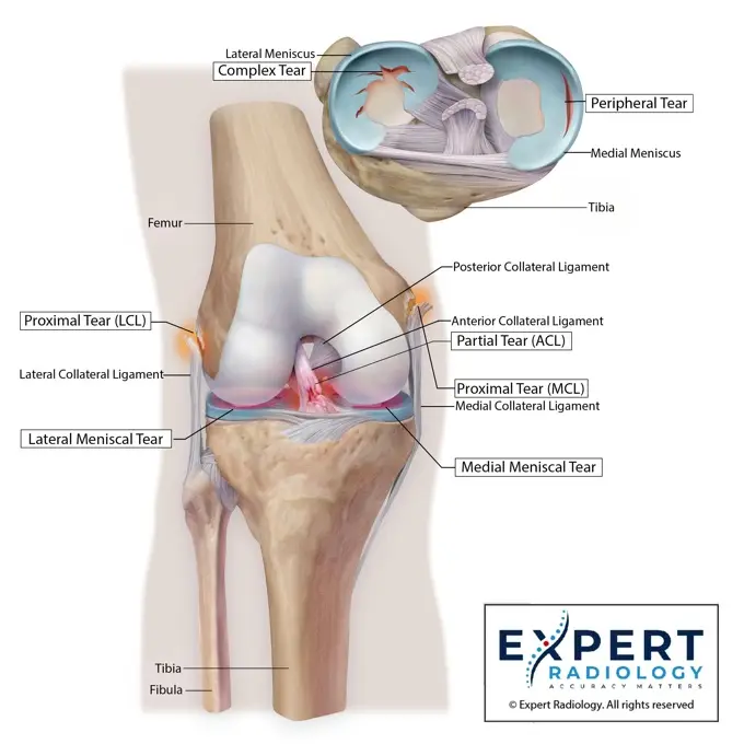 PrecisionPlus report page with a detailed knee illustration
