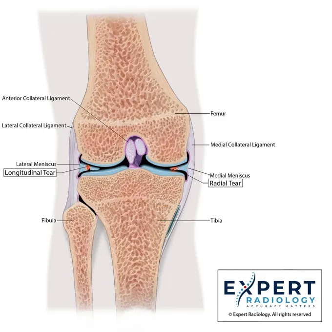 PrecisionPlus report page with a frontal knee illustration
