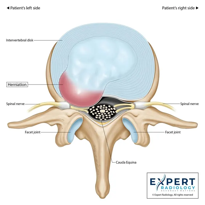 PrecisionPlus report page with an annotated lumbar spine image