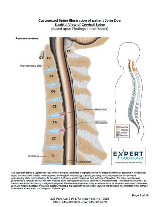 PrecisionPlus spine report page